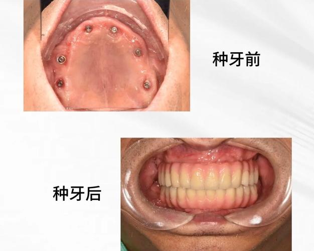 种植牙种植_全口种植牙齿怎么种_牙齿的种植牙