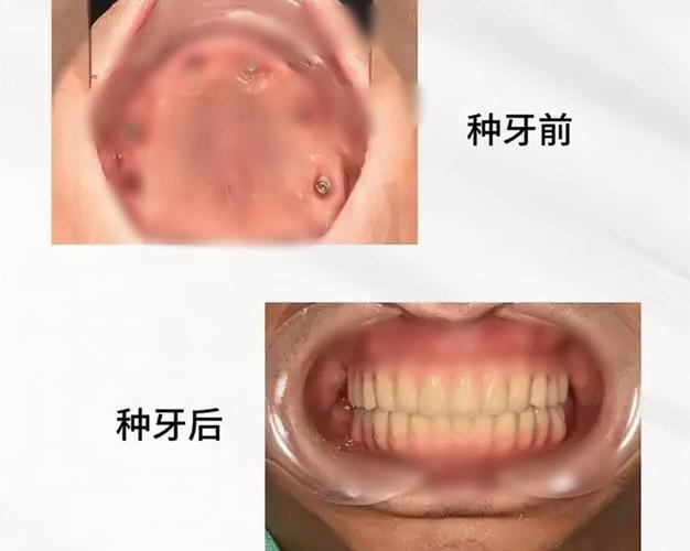 70多岁还能种牙吗?种牙风险大不大?