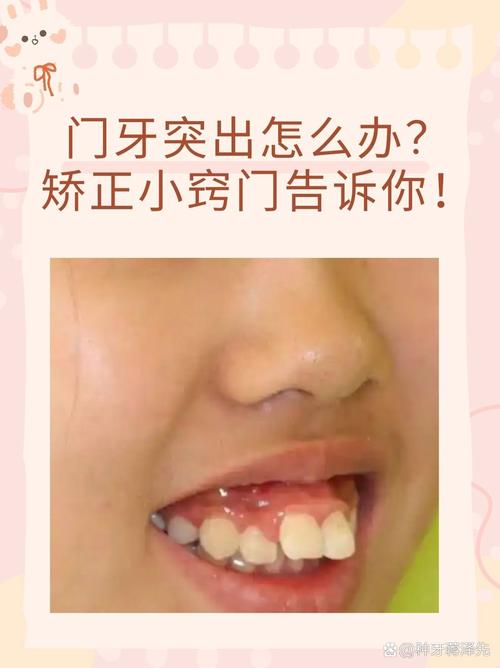 门牙突出矫正视频_10岁儿童门牙突出最快矫正方法_矫正突出门牙儿童方法图片
