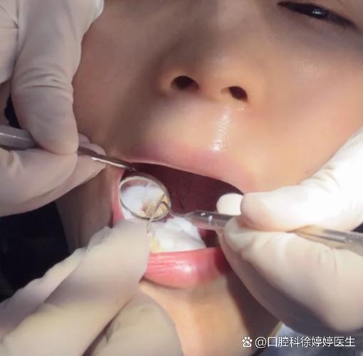 孕期牙龈炎怎么办_怀孕牙龈炎影响胎儿吗_孕期牙龈炎症