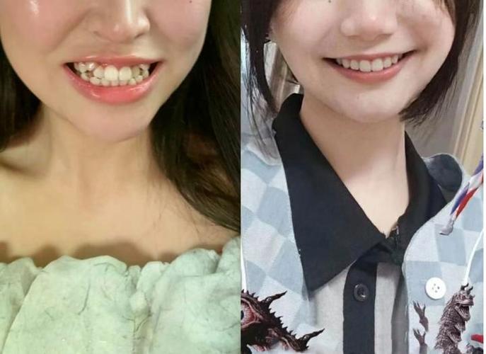 牙齿矫正能报销吗_牙齿矫正能改变脸型吗_36岁能矫正牙齿吗