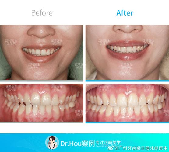 牙齿矫正能报销吗_牙齿矫正能改变脸型吗_36岁能矫正牙齿吗