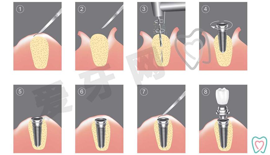 种植牙和烤瓷牙区别 优缺点对比_牙齿种植和烤瓷牙区别_种植牙和烤瓷牙优缺点