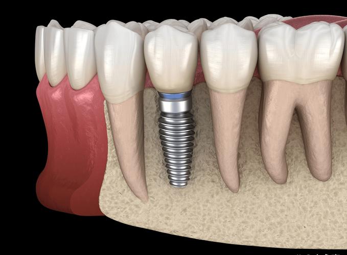 牙齿种植和烤瓷牙区别_种植牙和烤瓷牙优缺点_种植牙和烤瓷牙区别 优缺点对比