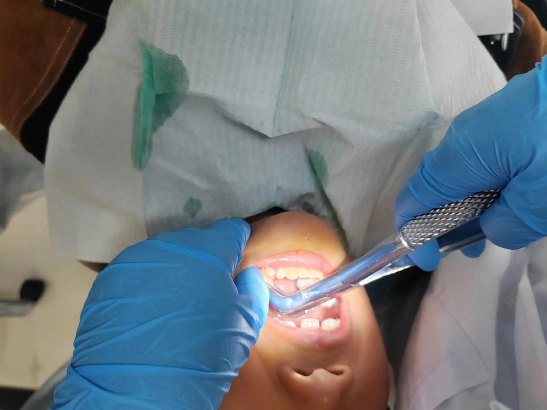 拔牙加种植牙恢复需要多久_拔牙后种植牙齿多少钱_拔一颗牙种植一棵还是补3棵