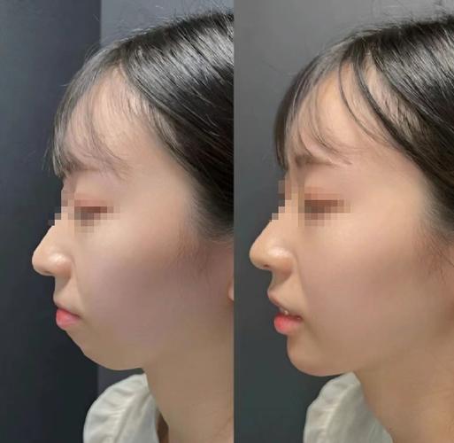 儿童下巴后缩矫正牙齿_缩下巴牙齿矫正儿童后注意什么_缩下巴牙齿矫正儿童后会反弹吗