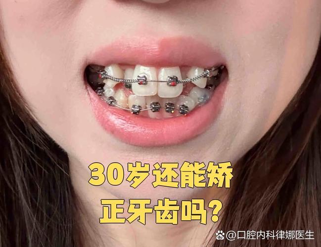 30岁龅牙可以矫正回来吗_龅牙矫正完可以改善脸型吗_龅牙矫正完后会不会反弹