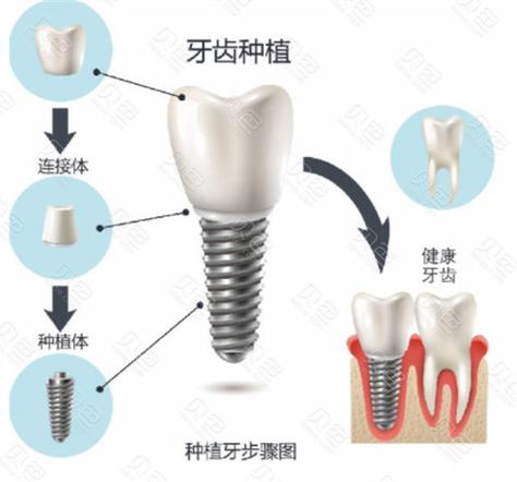 九江国产种植牙 威高价格 2026_九江国产种植牙 威高价格 2026_九江国产种植牙 威高价格 2026