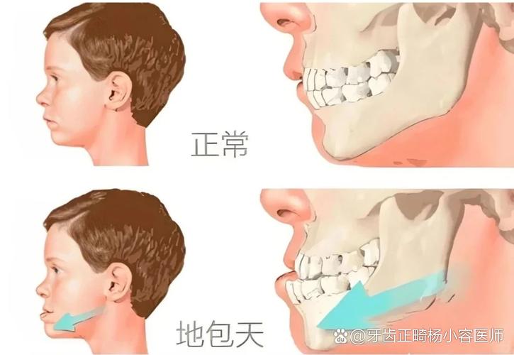 12岁小孩能做牙齿矫正吗?别等换完牙才后悔