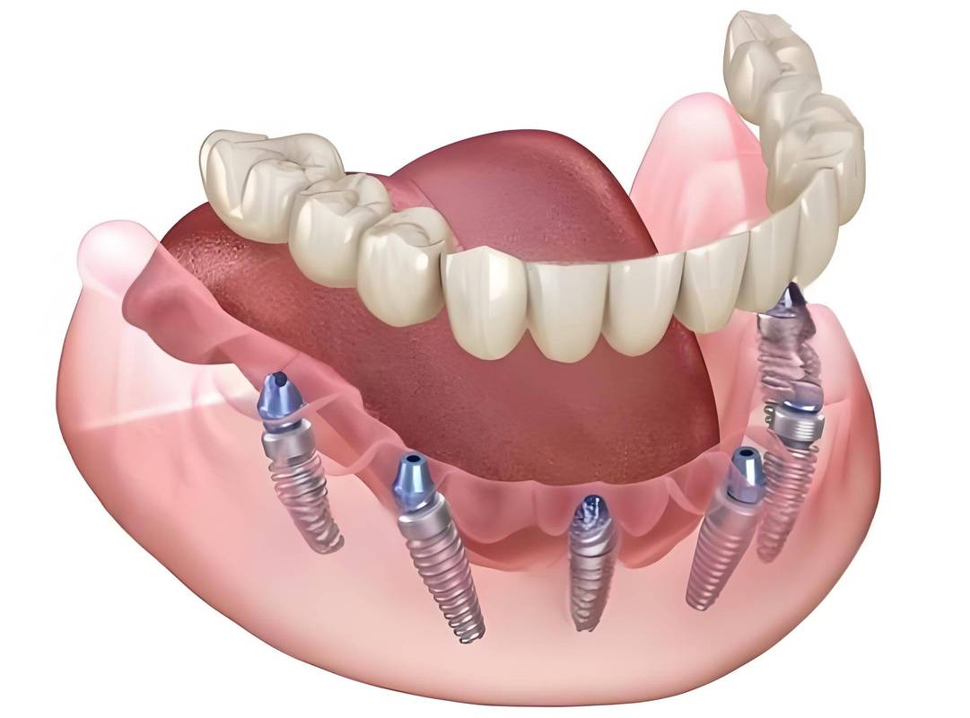 半口种植牙价格比较_牙种植口价格比较高的原因_种植牙口腔多少钱