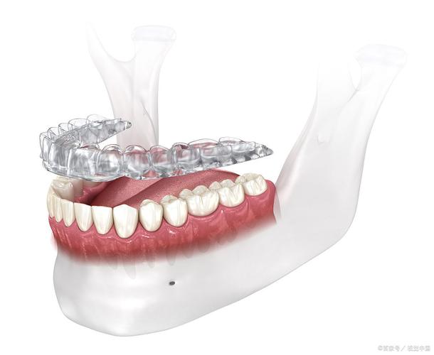 隐形矫正牙齿一般要花多少钱_隐形矫正牙套价目表_半隐形矫正牙
