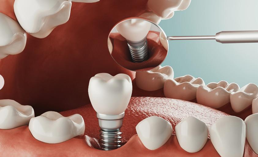 拨完牙种植牙_种植牙拔牙后注意事项_种植牙拔牙后
