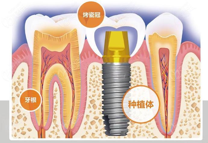 种植牙拔牙后注意事项_拨完牙种植牙_种植牙拔牙后
