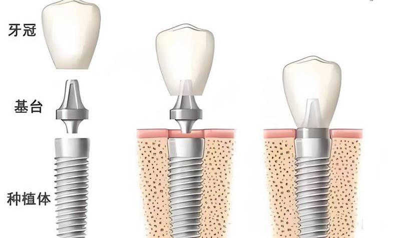 种植牙拔牙后注意事项_拨完牙种植牙_种植牙拔牙后
