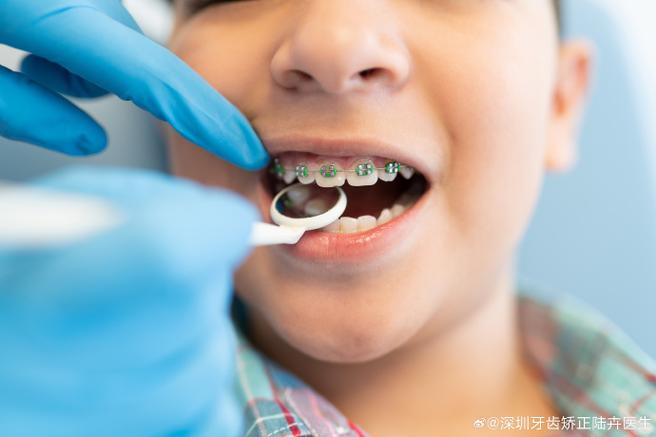 8岁儿童门牙龅牙怎么矫正_儿童矫正门牙齿要多少钱一个_孩子矫正门牙