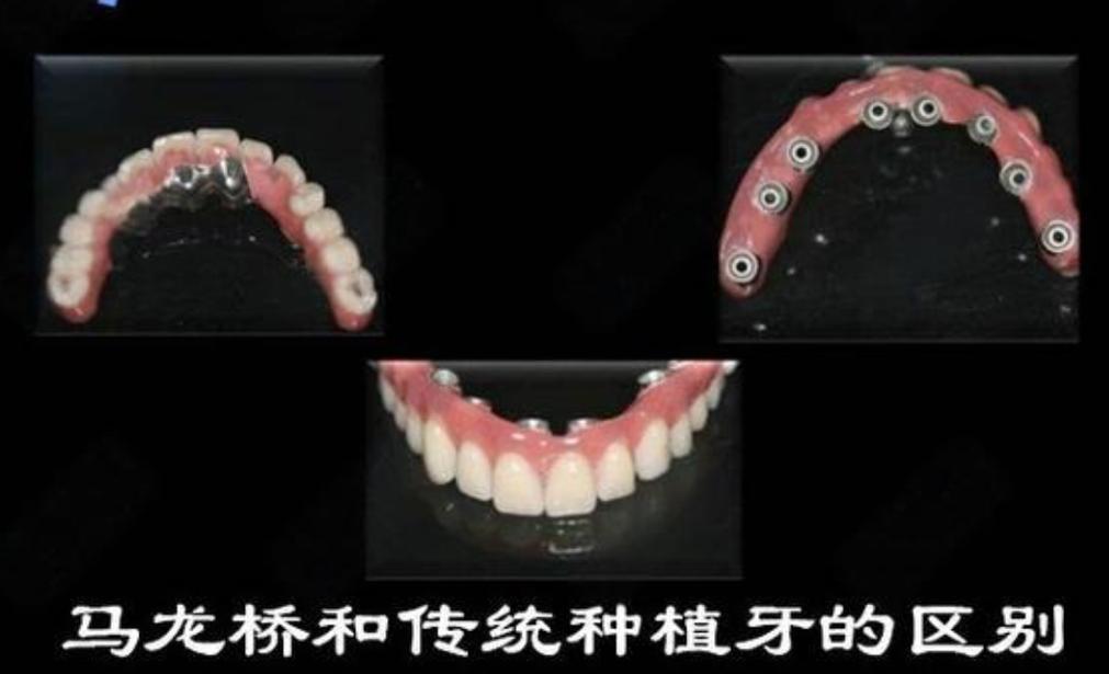 大同种牙哪里好_大同镶牙哪里好_大同种牙价格