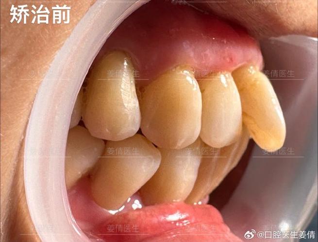 牙齿矫正可以只矫正下面一排吗_牙齿矫正可以只矫正几颗吗_60岁牙齿可以矫正吗