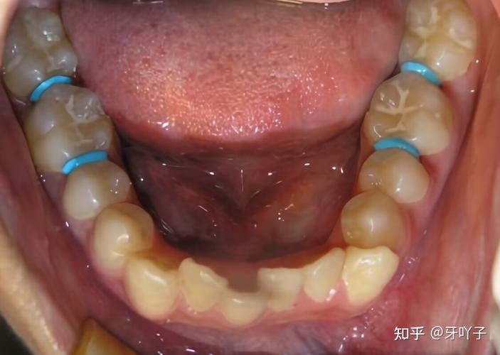 玉林牙齿矫正效果怎么样?看完这篇就心里有数了