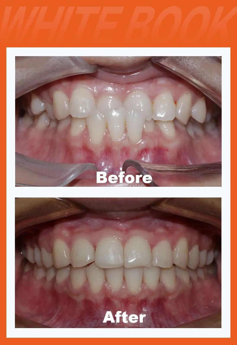 50岁门牙突出可矫正吗_矫正门牙突出一般多少钱_矫正突出门牙可以矫正吗