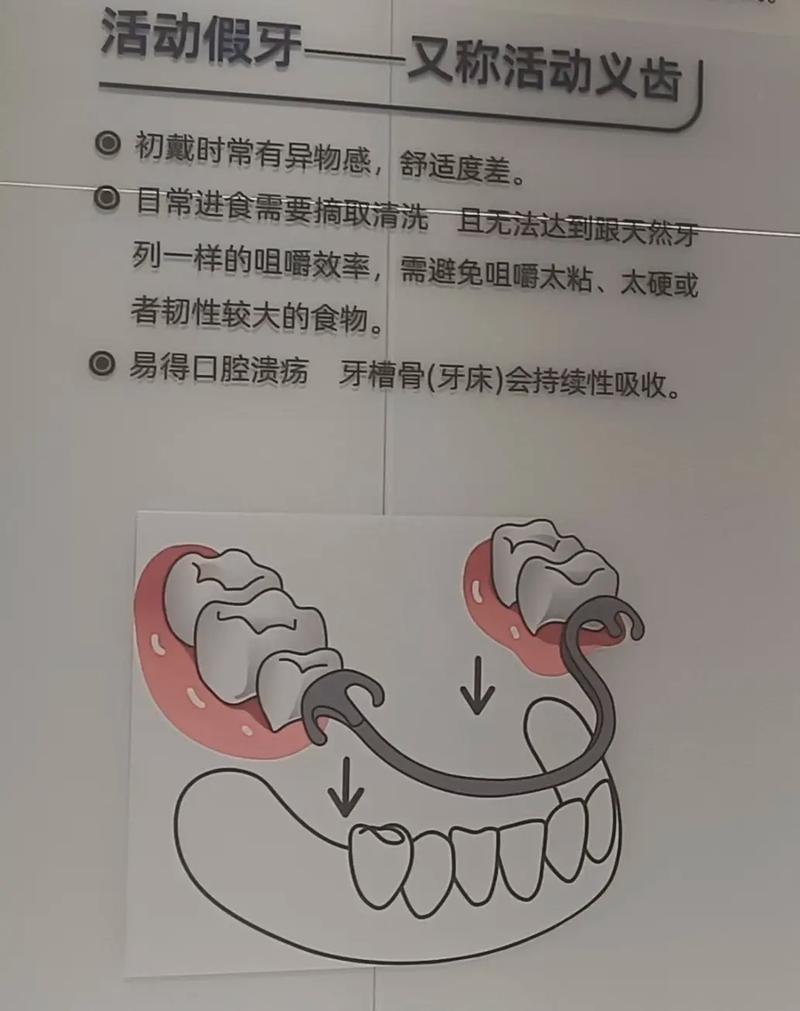 固定假牙种牙_活动假牙固定假牙种植牙哪个好_种牙假牙是连在一起的吗