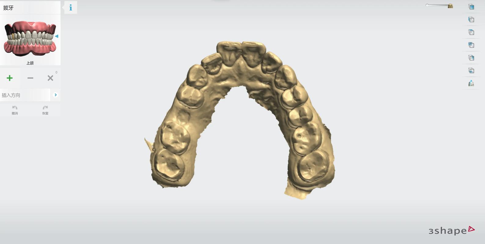 数字导板种植牙_3d导板数字化种植牙_3d数字化种植牙缺点