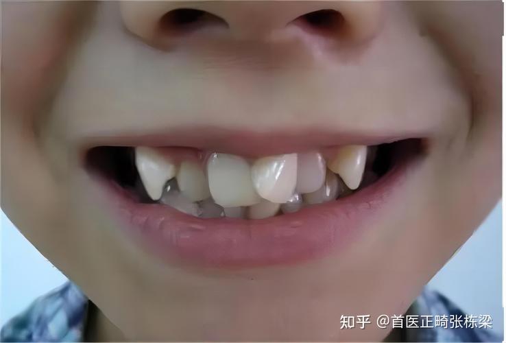 深圳治疗地包天哪家医院好_儿童地包天矫正医院_深圳儿童地包天最佳矫正年龄