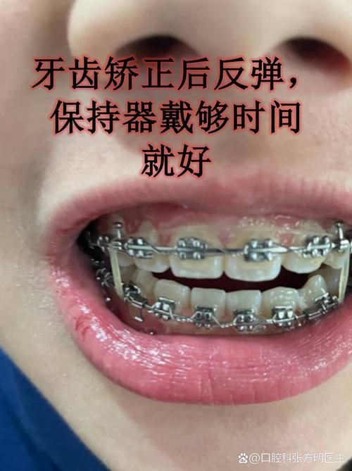 牙齿矫正做可以用医保吗_牙齿矫正能_19岁可以做牙齿矫正吗