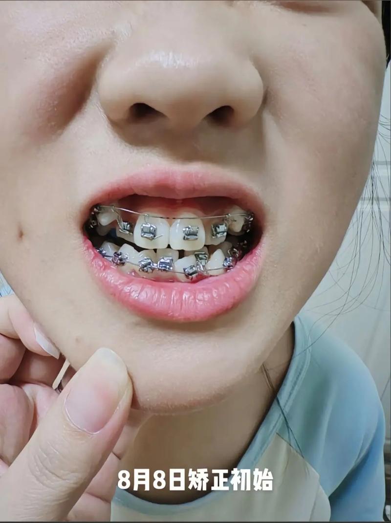 19岁可以做牙齿矫正吗_牙齿矫正做可以用医保吗_牙齿矫正能
