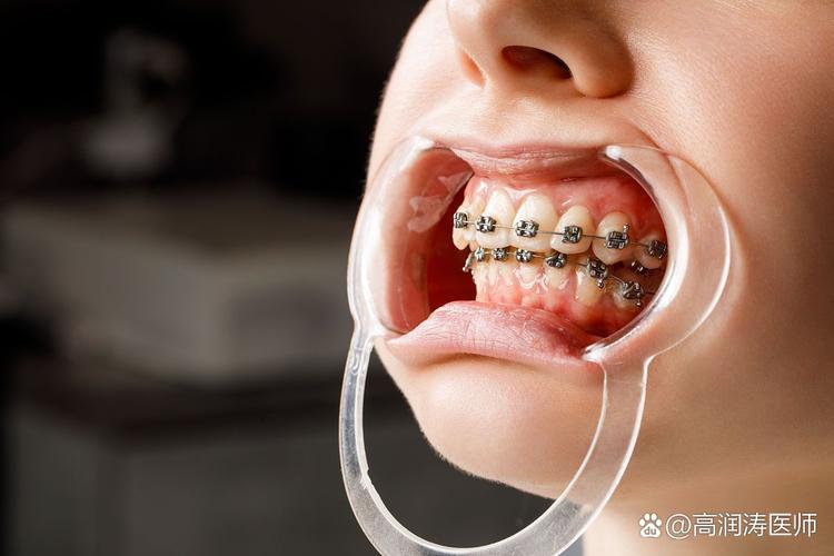 成人牙齿矫正费用大概多少_成人如何牙齿矫正_成人牙齿矫正需要多久时间