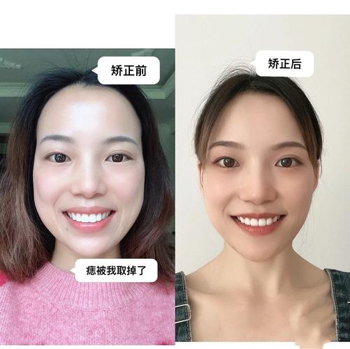 成年牙齿矫正后保持器要戴多久_成年牙齿矫正可以后改善吗_成年后牙齿可以矫正吗