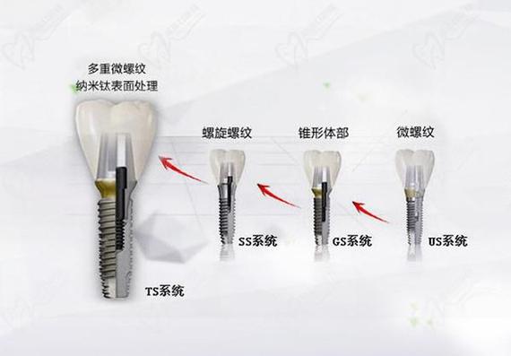 唐山市种牙哪家医院好_唐山种植牙价格_唐山韩系奥齿泰种植牙费用 2026
