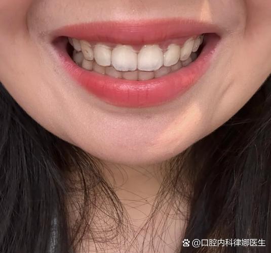 23岁还可以做牙齿矫正吗_矫正牙齿可以做手术吗_牙齿矫正做可以吃饭吗