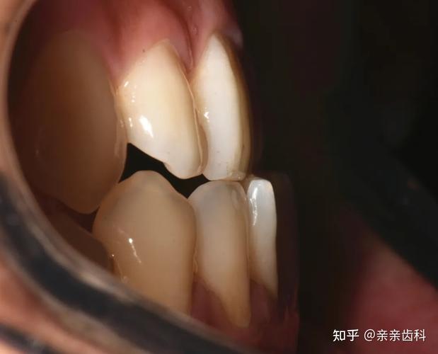 宿迁牙齿矫正大概要花多少钱?本地人帮你算笔账