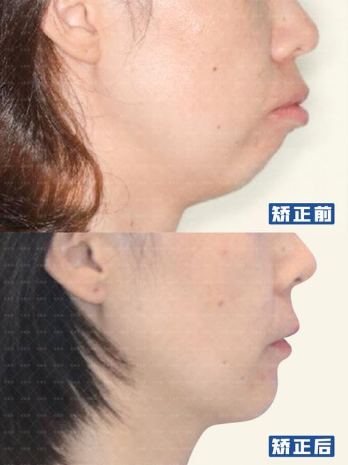 缩下巴牙齿矫正后会反弹吗_矫正牙齿下巴后缩_矫正牙齿下巴后缩可以改善多少