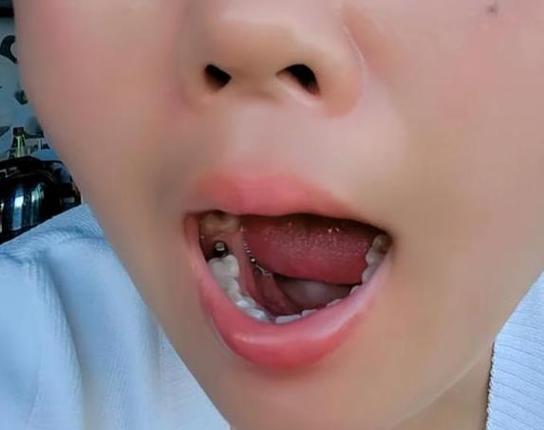 大庆世同什么地方种牙好_大庆种牙多少钱一颗啊_大庆市种植牙的材料及价格表