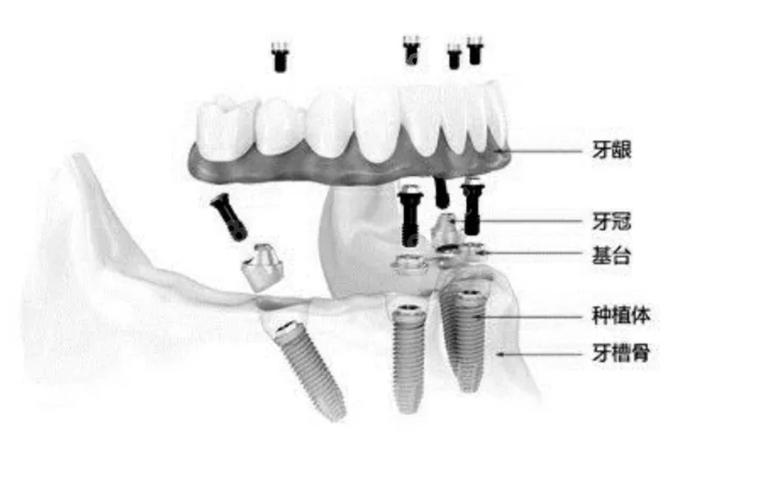 牙齿咋种_半口种牙齿多少钱一颗_牙齿满口种植