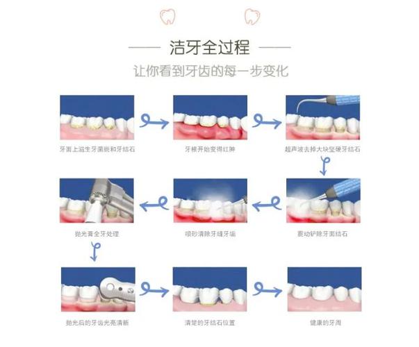 深圳宝安隐适美正品认证医院_深圳隐适美矫正大概多少钱_深圳最厉害的隐适美医生