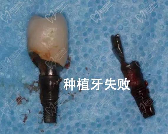 福田牙科医院哪个好_深圳福田单颗种植牙哪家医院靠谱_深圳福田牙齿矫正哪家好