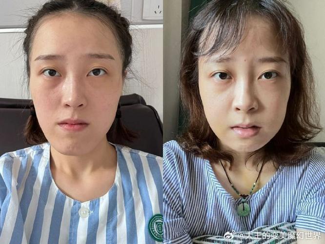 深圳福田成人地包天正畸医院_深圳治疗地包天哪家医院好_深圳正畸价格