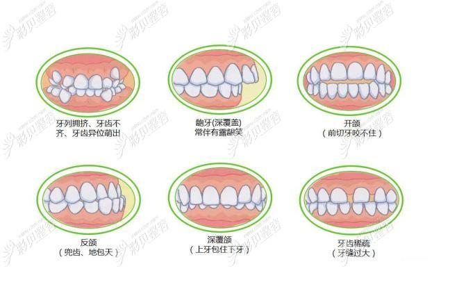 南阳牙齿矫正多少钱?2026最新价格大公开