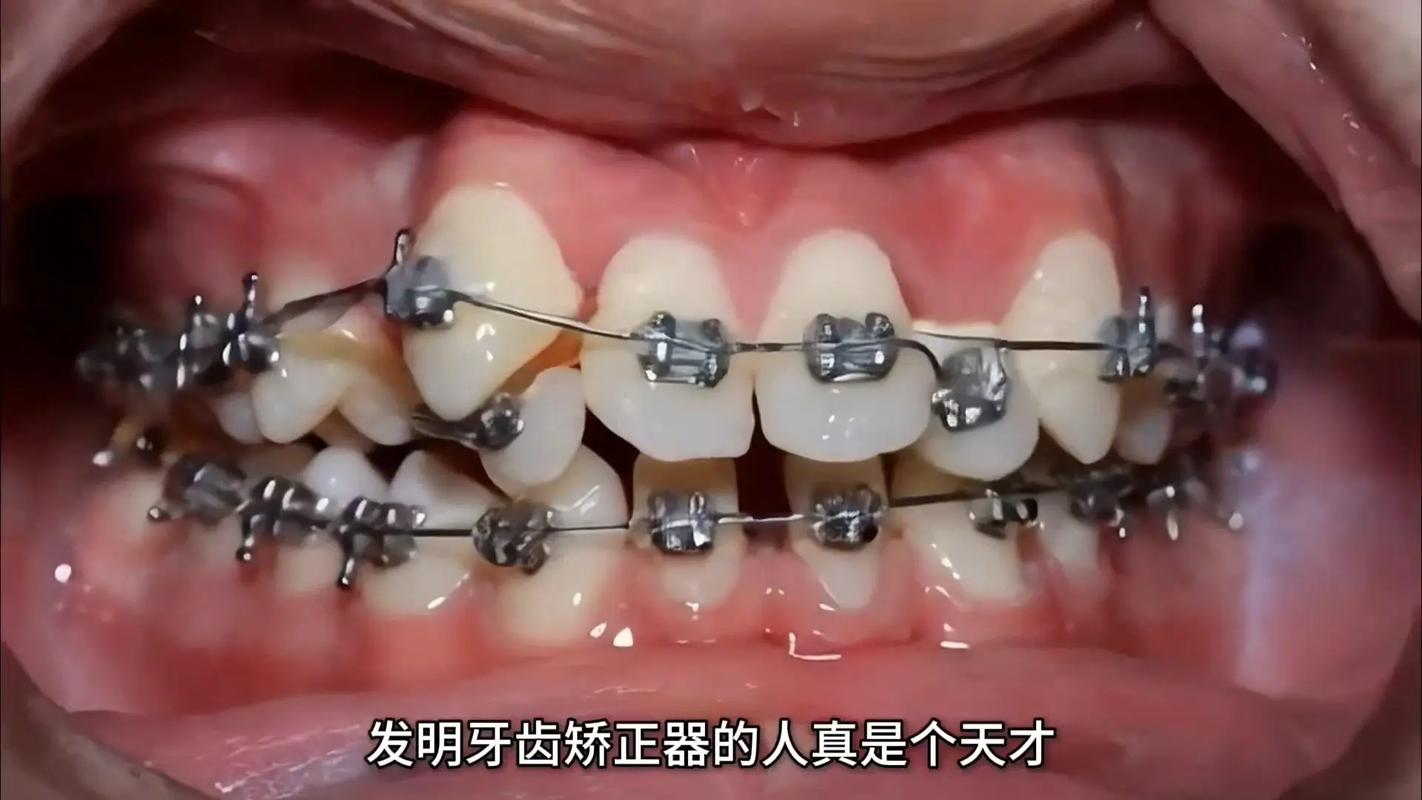 宝鸡整牙_宝鸡牙齿矫正多少钱_宝鸡牙齿矫正一般多少钱