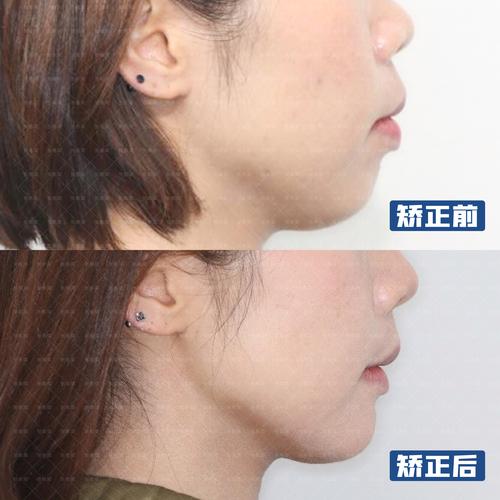 30多岁还能牙齿矫正吗_牙齿矫正还能当兵吗_牙齿矫正还能吹号吗