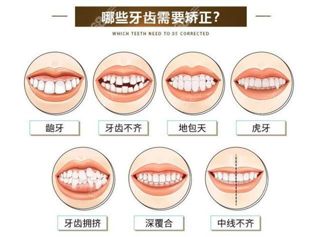 儿童牙齿几岁可以矫正_牙齿矫正小孩_牙齿矫正儿童可以做吗