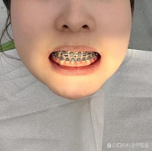 牙齿矫正突出还能外扩吗_牙齿突出矫正后会改变脸型吗_33岁牙齿向外突出还能矫正吗