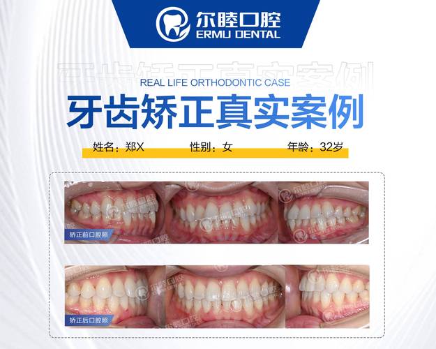成人矫正牙齿咬合疼不疼？效果和费用全解析
