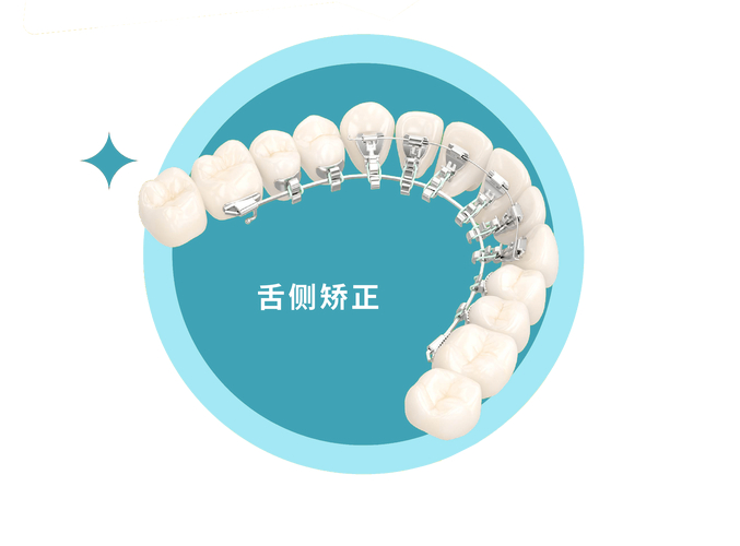 隐形舌侧正畸牙套_牙齿矫正是做舌侧好还是隐形好_成年人牙齿舌侧隐形正畸