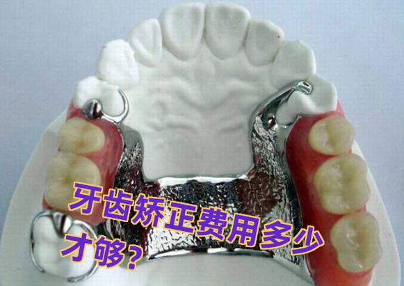 长沙矫正牙齿大概要多少钱_长沙牙齿矫正收费标准_长沙矫正龅牙