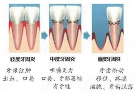 深圳牙周炎治疗费用_深圳看牙周炎哪个医院好_深圳牙周炎治疗可以医保报销吗