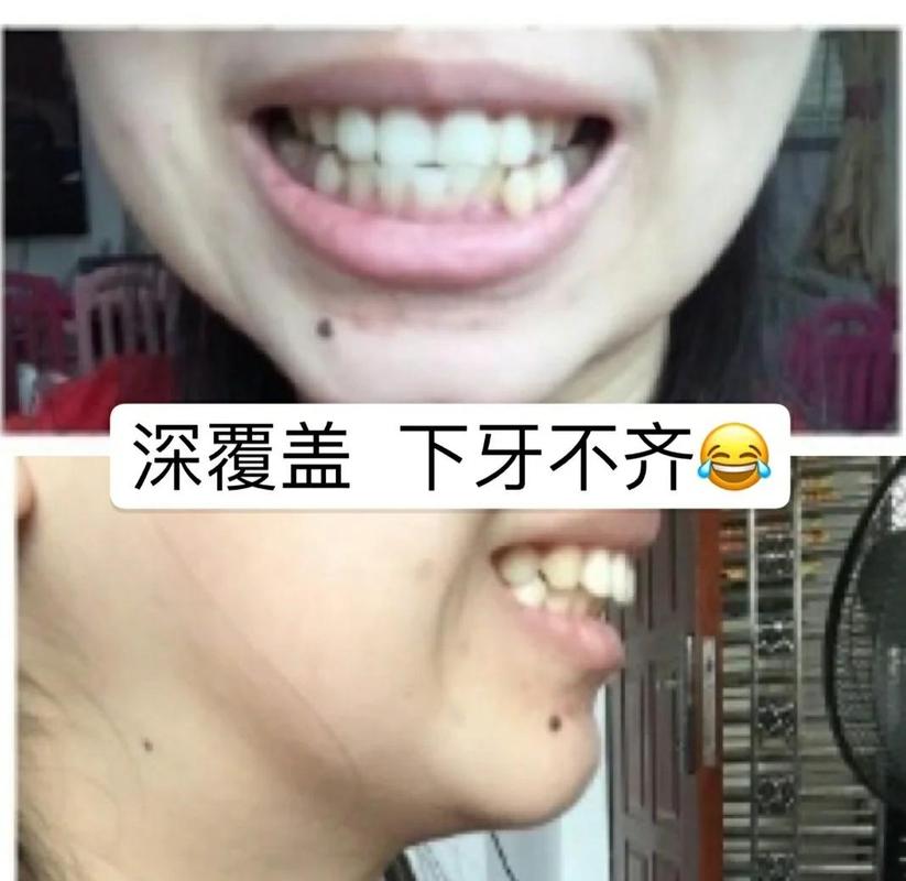 效果牙齿矫正有用吗_效果牙齿矫正有什么好处_39岁牙齿矫正有效果吗