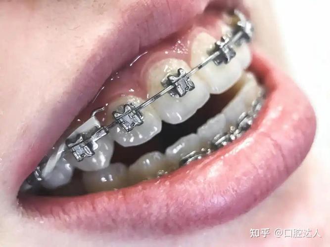 牙齿矫正的钱一次付吗_牙齿矫正可以退钱吗_30岁还可以矫正牙齿要多少钱